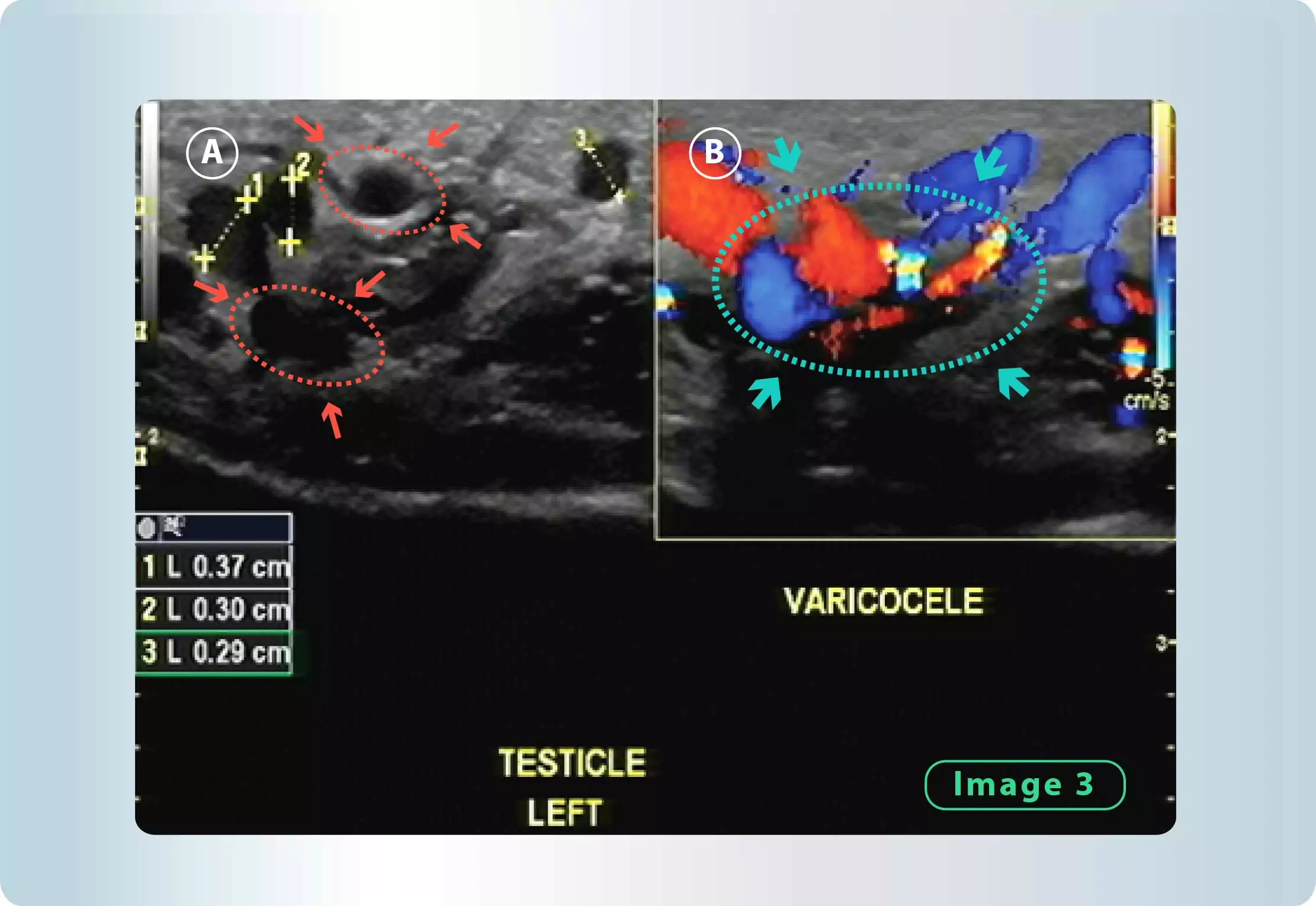 Varicocle (Dilated Veins) | Georgiadis Urology