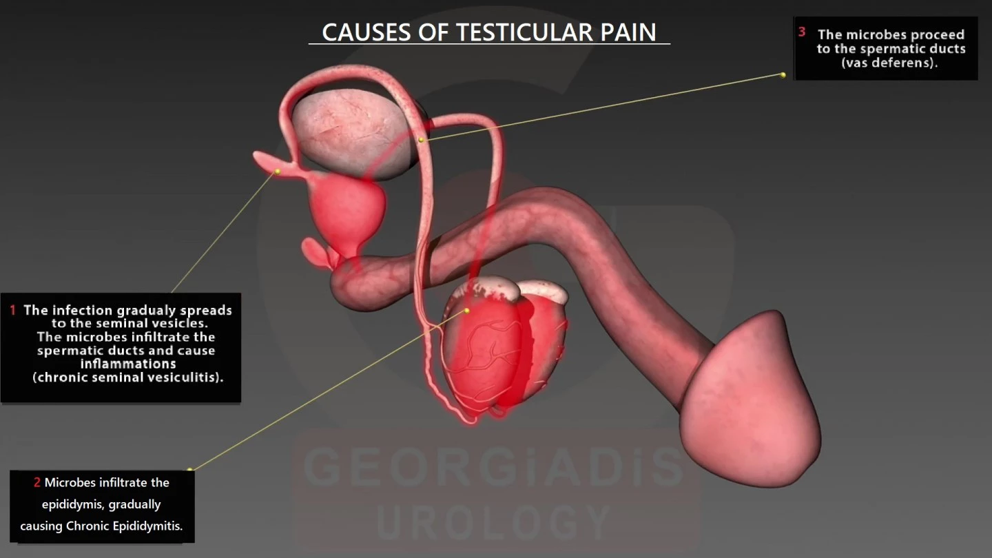 Testicular Pain | Georgiadis Urology