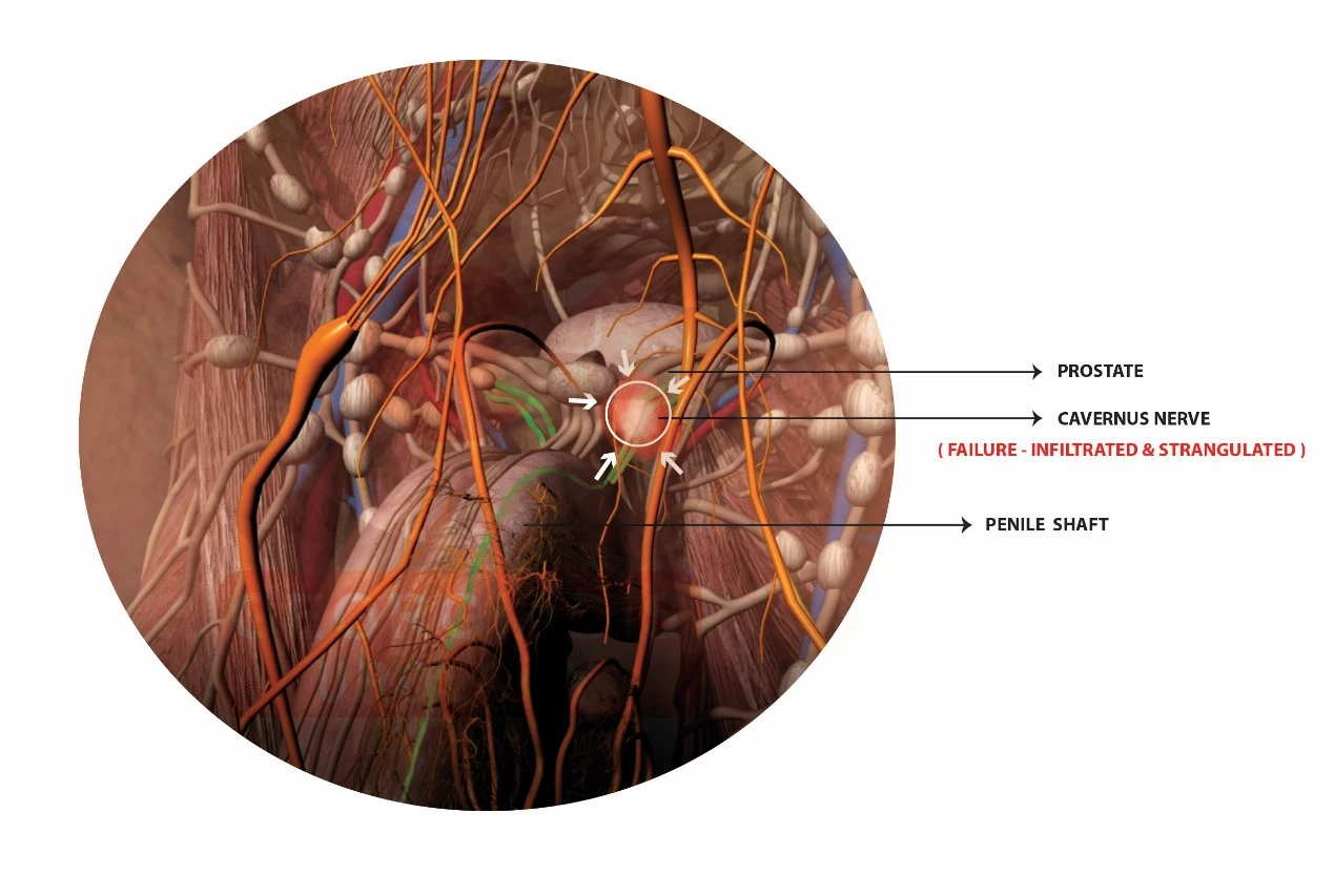Cavernous nerve inflammatory infiltration | Georgiadis Urology