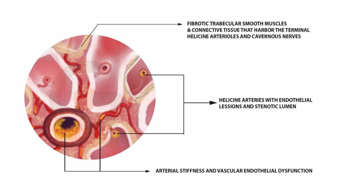 Erectile Tissue changes due to Chronic Prostatitis | Georgiadis Urology.