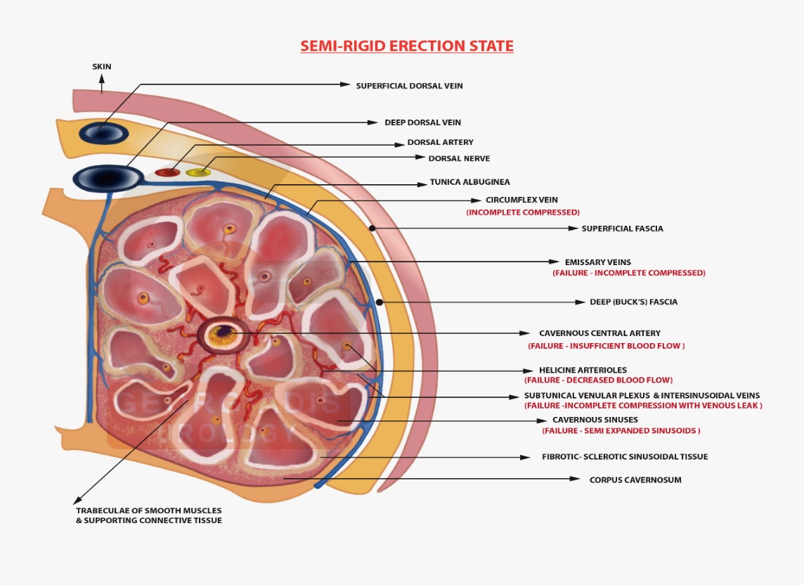 Semi-rigid penile state in erectile dysfunction | Georgiadis Urology