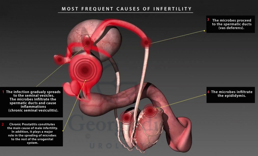 Most frequent causes of infertility in men | Georgiadis Urology