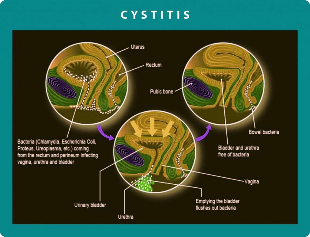 Chronic Cystitis | Georgiadis Urology