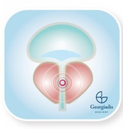 chronic prostatitis graphic | georgiadis urology