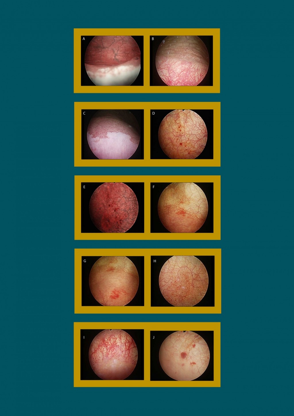 Types of Cystitis | Georgiadis Urology