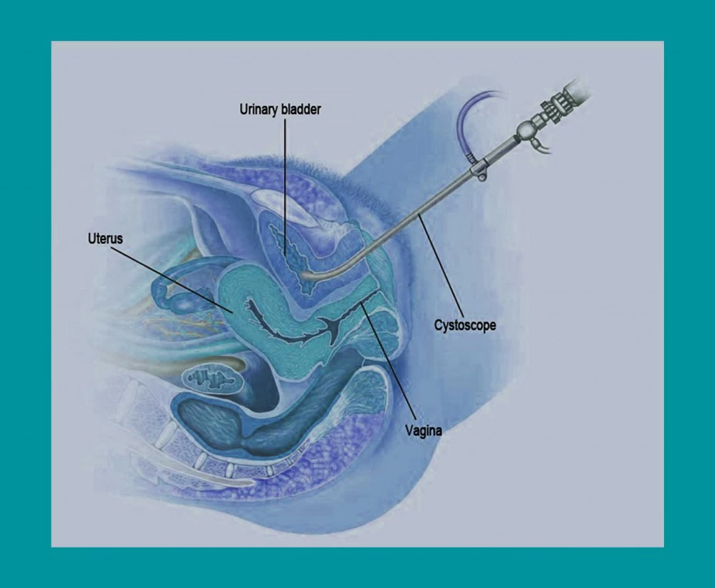 Cystoscopy for Cystitis | Georgiadis Urology