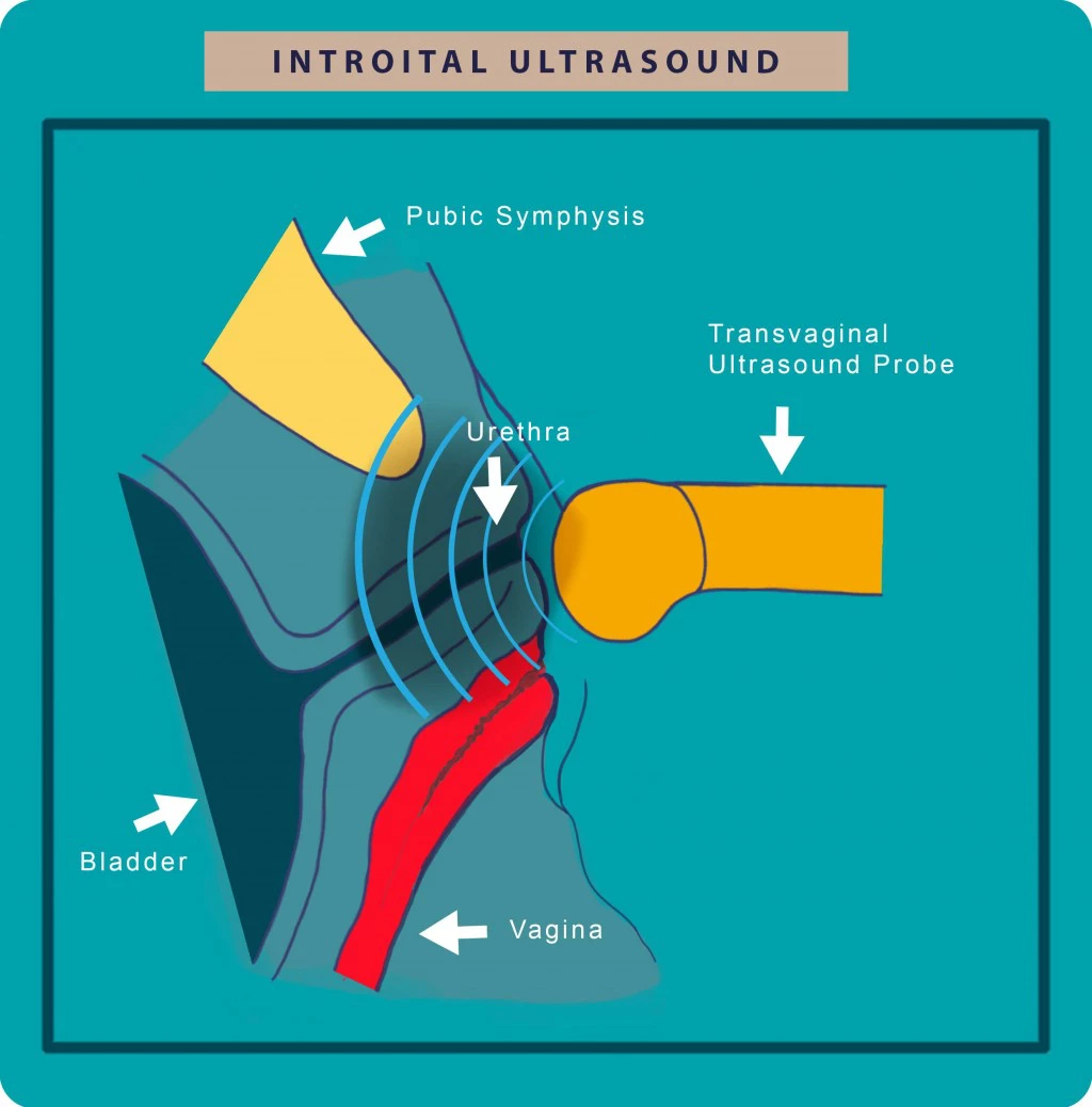 Introital ultrasound cystitis | Georgiadis Urology