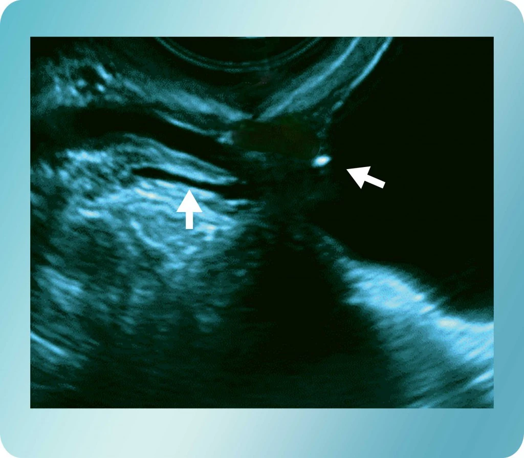 Transvaginal Sonogram for Cystitis | Georgiadis Urology