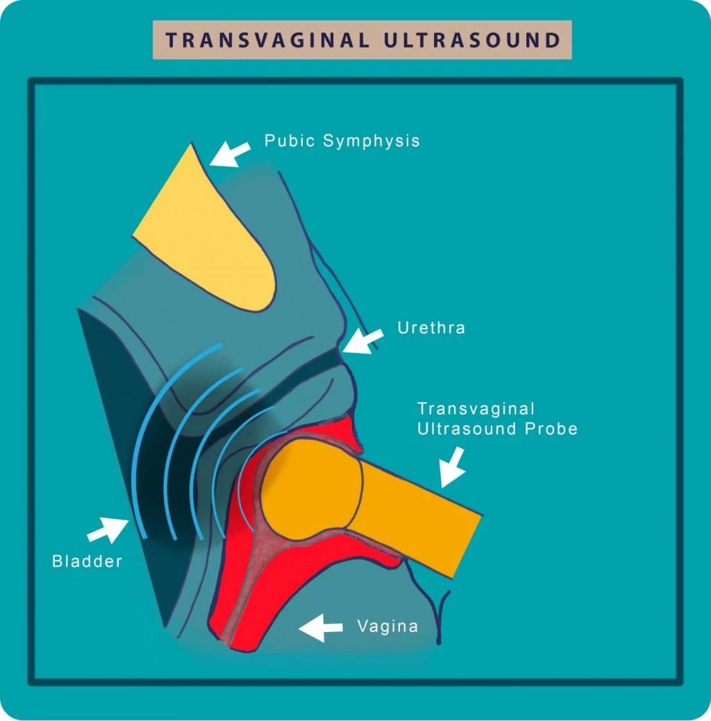 Transvaginal ultrasound cystitis | Georgiadis Urology