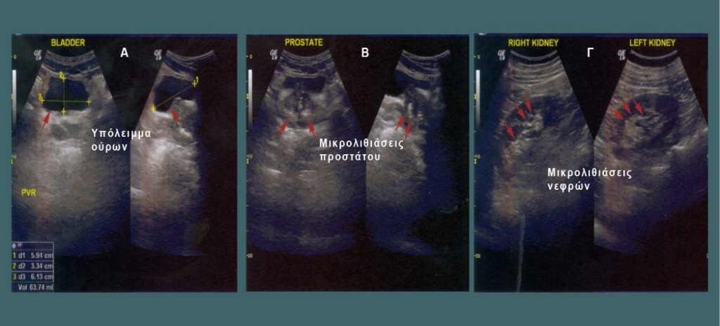 Kidney Ultrasound - Prostatitis Diagnosis - Georgiadis Urology