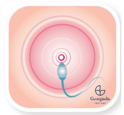 Infertility graphic | Georgiadis Urology