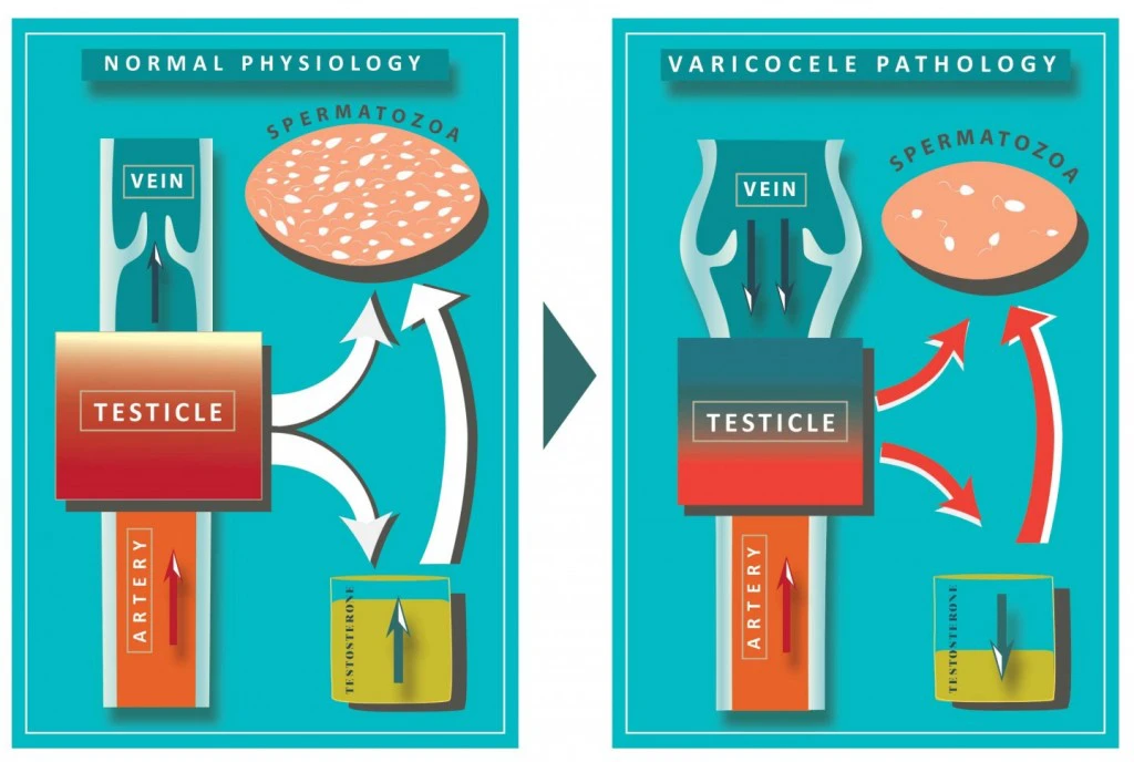Varicocele Pathology | Georgiadis Urology