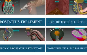 prostatitis treatment videos 3d georgiadis urology